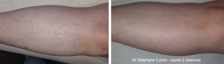 Avant / après traitement des varicosités sur les jambes
