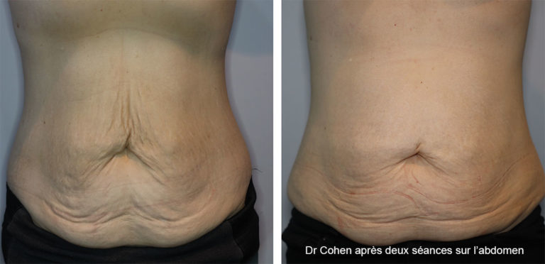 Avant / après traitement remise en tension cutanée du ventre par technique Legato - 2 séanceq par le Dr Stéphane Cohen