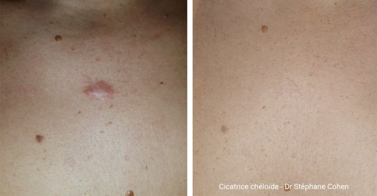 Avant / après traitement traitement d'une cicatrice chéloïde par le Dr Stéphane Cohen