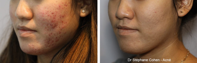 Avant / après traitement de l'acné par le Dr Stéphane Cohen