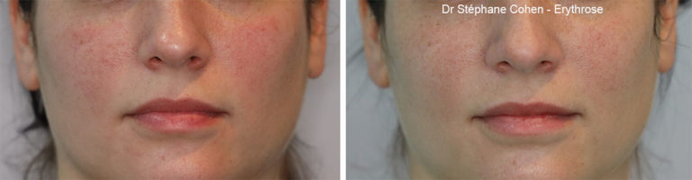 Avant / après traitement d'une érythrose sur les joues