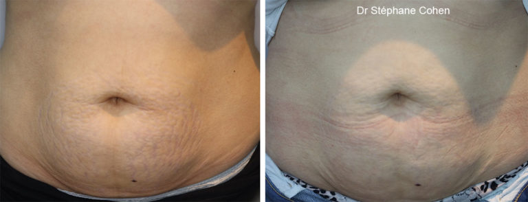 Avant / après traitement des vergetures sur le ventre par le Dr Stéphane Cohen