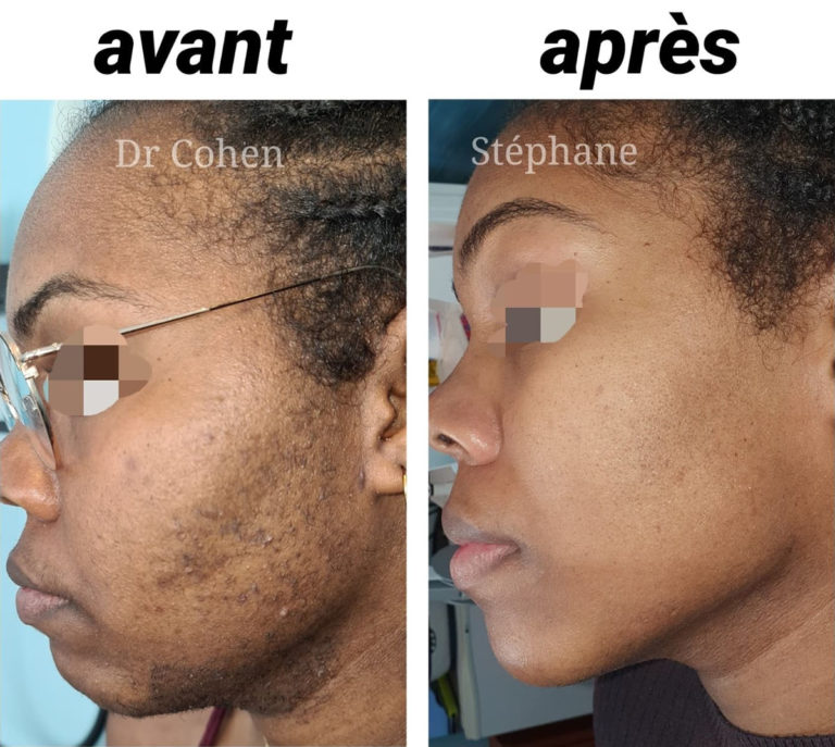 Avant / après épilation laser du visage par le Dr Stéphane Cohen