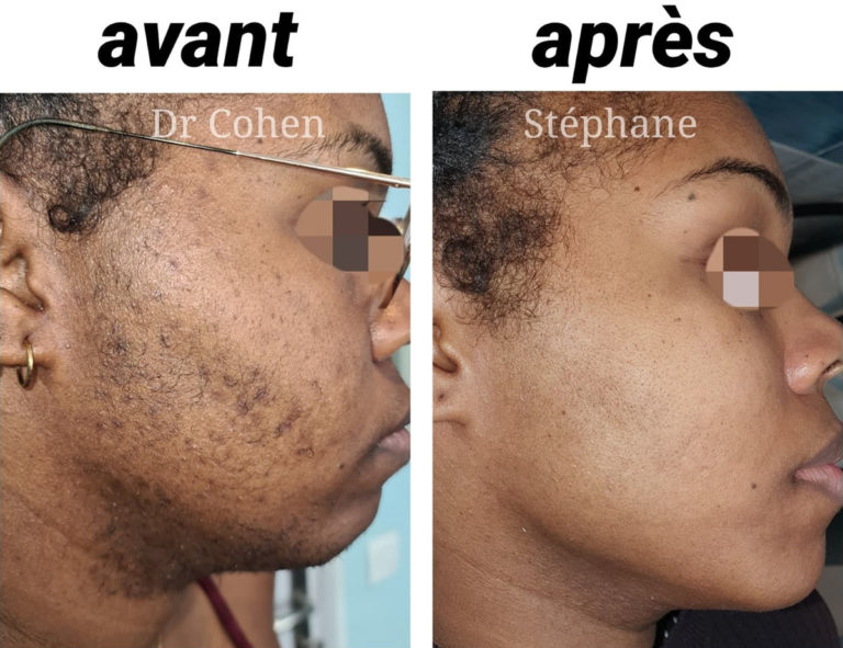 Avant / après épilation laser du visage par le Dr Stéphane Cohen