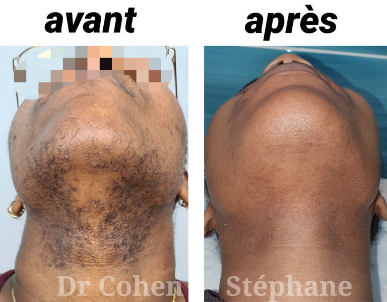 Avant / après épilation laser du visage par le Dr Stéphane Cohen