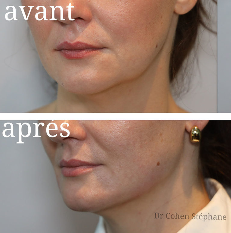 Avant / après traitement de l'ovale du visage par injections d'acide hyaluronique