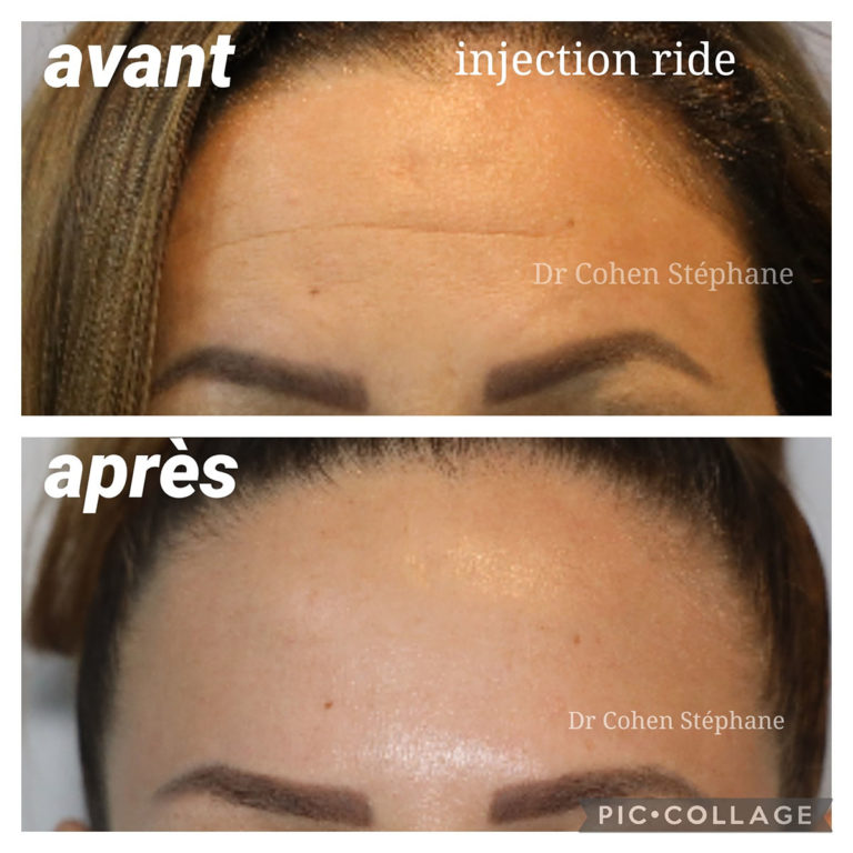 Avant / après traitement des rides du front par injections de Botox