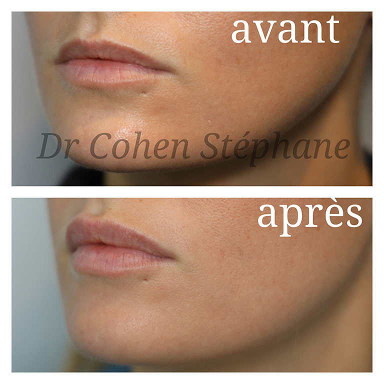 Avant / après traitement des lèvres par injections d'acide hyaluronique